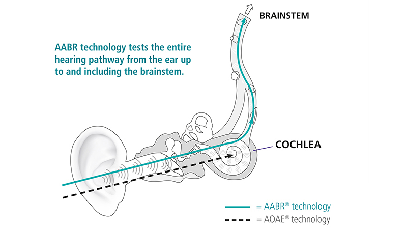 Diagram comparing AABR and OAE hearing screening technologies, showing signal pathways from the ear to the brainstem.