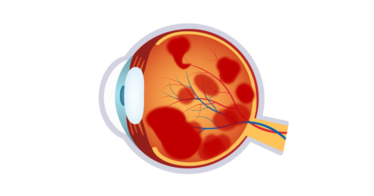 Pediatric Eye Disease:  Abusive Head Trauma