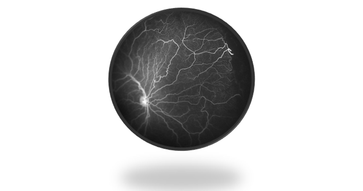 What is Fluorescein Angiography?