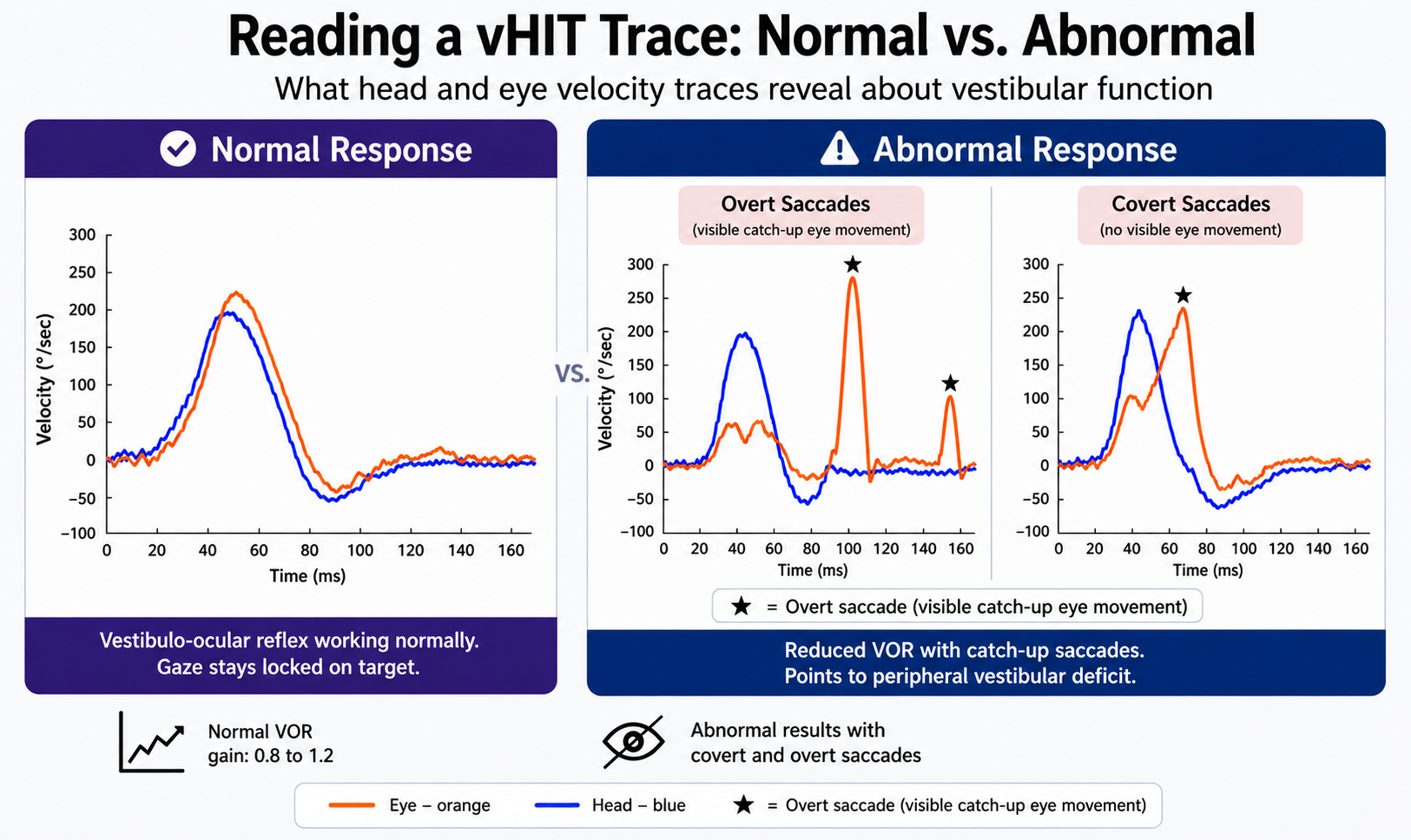 Reading a vHIT trace, normal response vs abnormal response (overt and covert saccades).