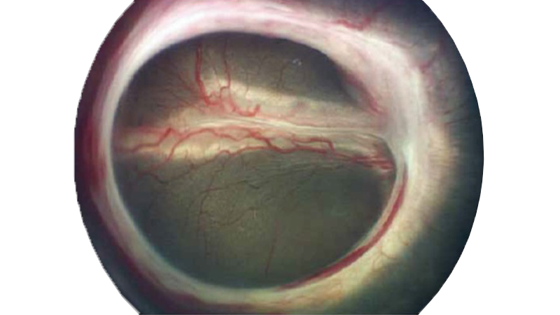 Retinal image showing advanced retinopathy of prematurity in a preterm infant, highlighting the importance of ROP screening in NICU settings.