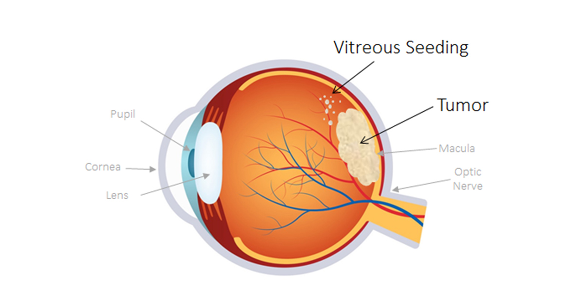 Pediatric Eye Disease:  Retinoblastoma