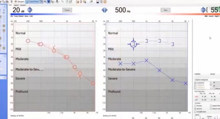Madsen Astera2 – Understanding your Hearing Test