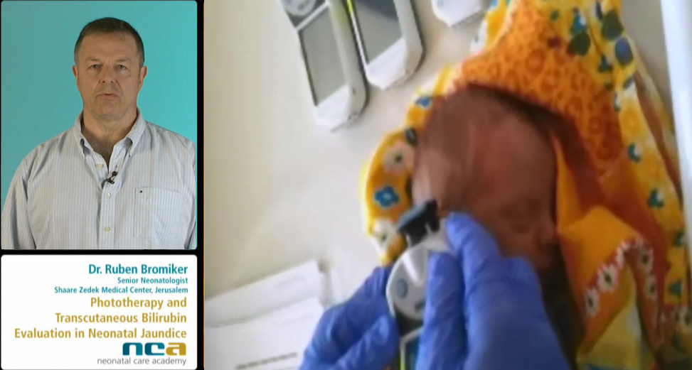 Phototherapy and TcB Evaluation