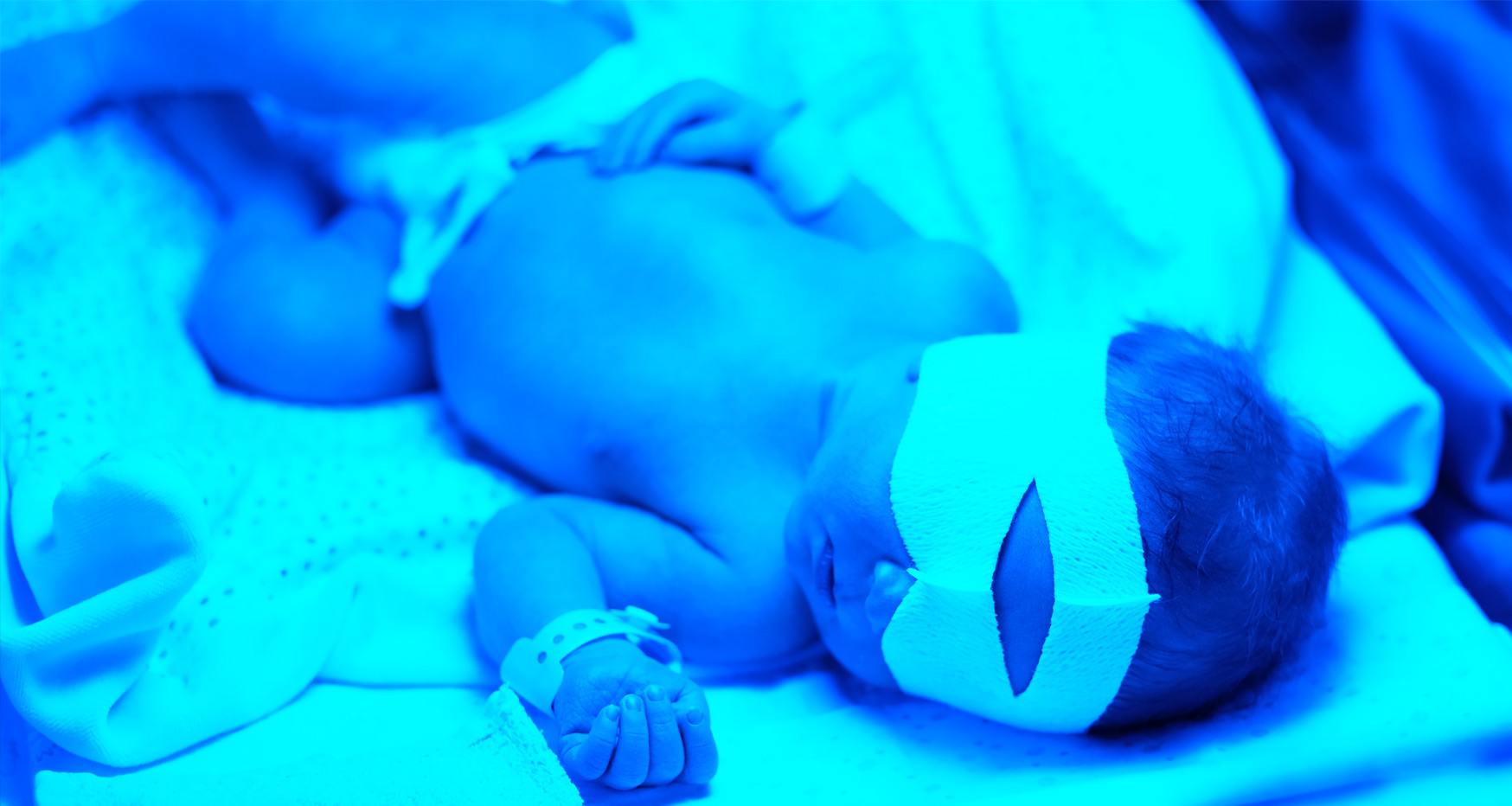 Care of the baby receiving Phototherapy