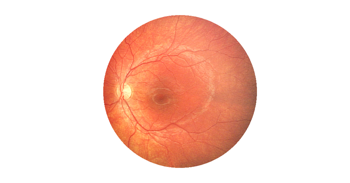 What is Retinal Photography?