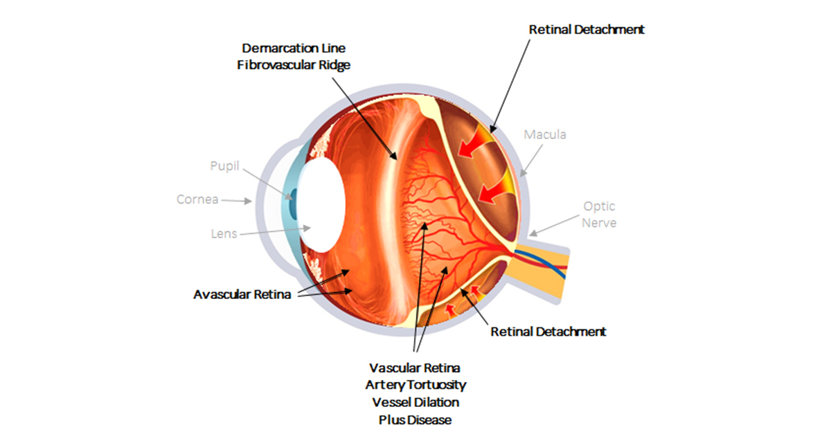 Pediatric Eye Disease:  Retinopathy of Prematurity